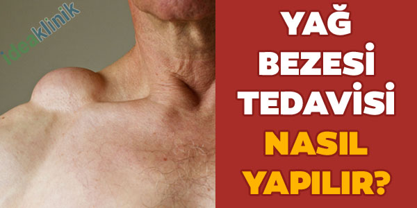 yağ bezesi tedavisi