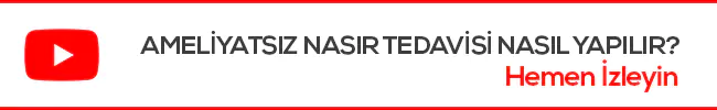 ameliyatsız nasır tedavisi youtube