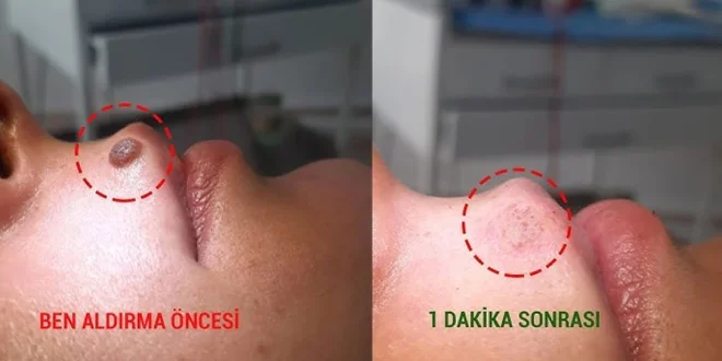 Ben aldırma sonrası süreç