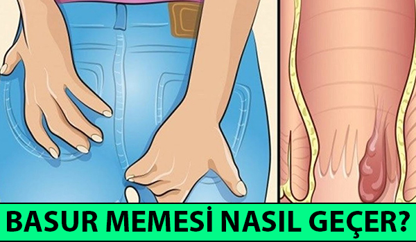 basur memesi nasıl geçer