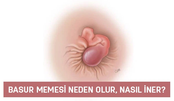 basur memesi neden olur